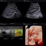  Máy siêu âm X-CUBE 70 