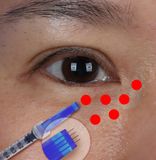  KIM TỨ LINH KIM TIÊM MESO 4 ĐẦU 34G 1,2MM 