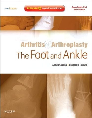 Arthritis and Arthroplasty: The Foot and Ankle