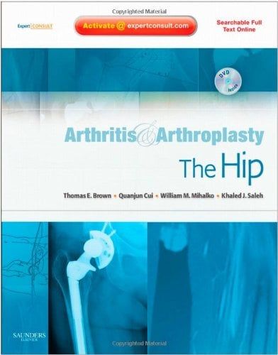 Arthritis and Arthroplasty: The Hip