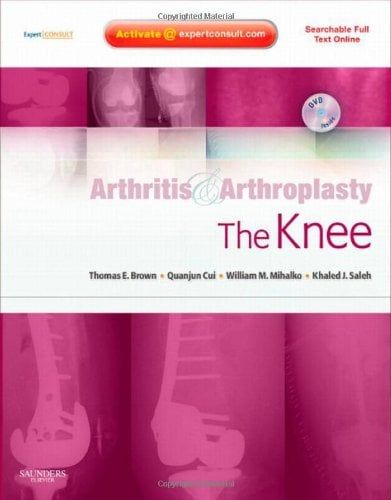 Arthritis and Arthroplasty: The Knee