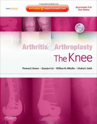 Arthritis and Arthroplasty: The Knee
