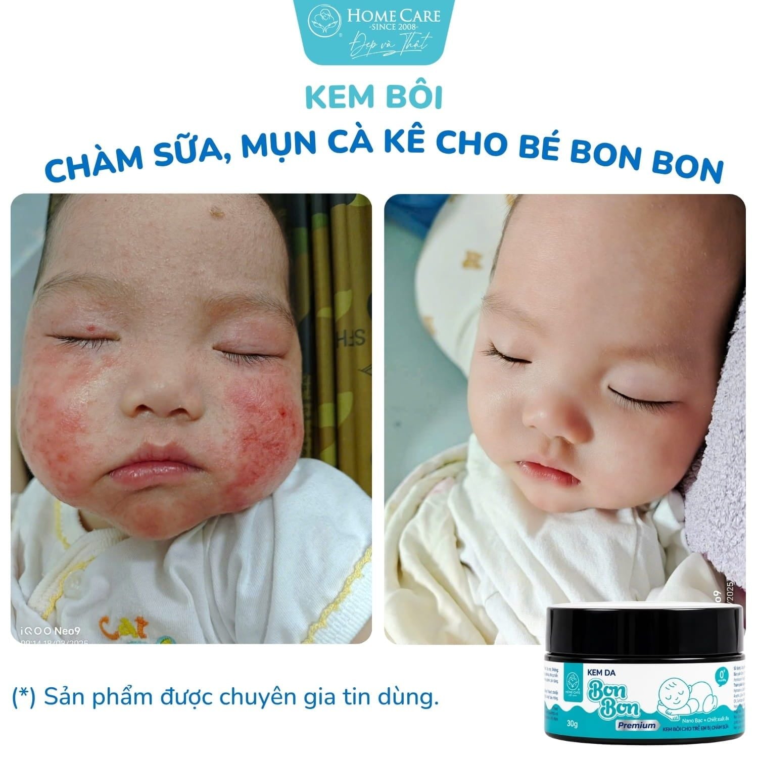 Hai má mẩn đỏ, khô ráp