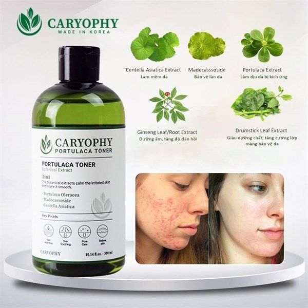 Nước Hoa Hồng Caryophy Ngừa Mụn Kiềm Dầu Giảm Thâm 300ml