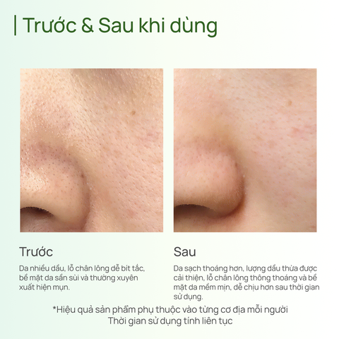 Sữa Rửa Mặt Kiểm Soát Dầu và Hỗ Trợ Ngăn Ngừa Mụn CHANDO Himalaya 150ml Hàng Chính Hãng