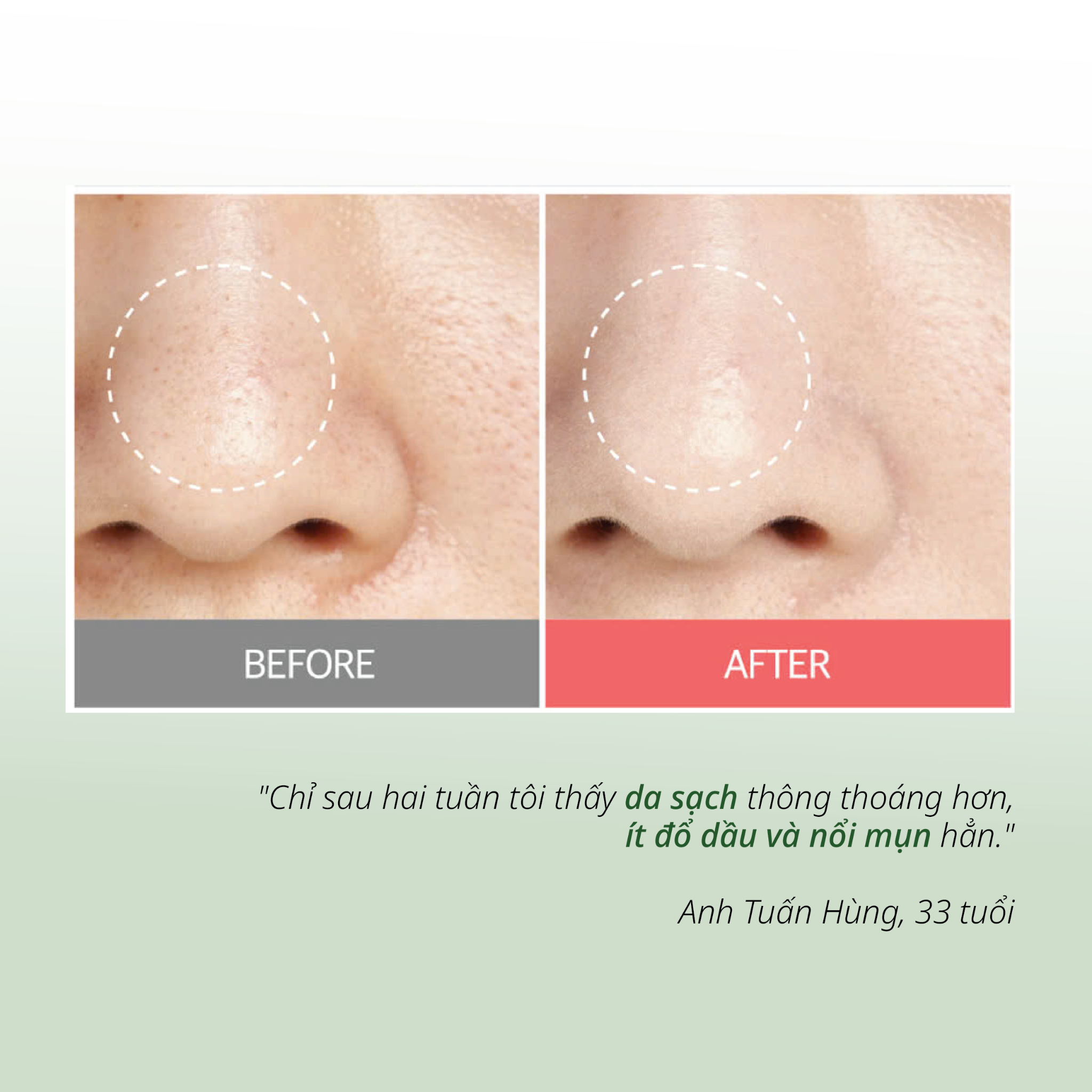 Toner Hỗ Trợ Kiểm Soát Dầu Giảm Mụn Salicylic Acid CHANDO Himalaya 150ml Hàng Chính Hãng