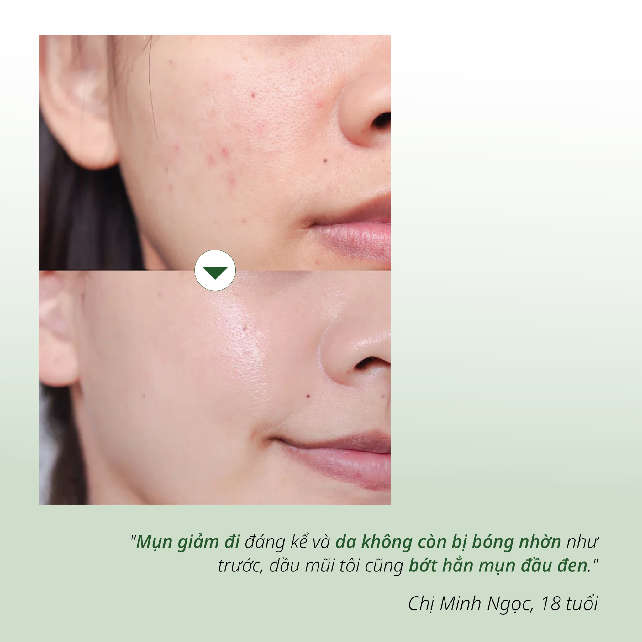 Tinh Chất Hỗ Trợ Kiểm Soát Dầu và Giảm Mụn Salicylic Acid CHANDO Himalaya 40ml Hàng Chính Hãng