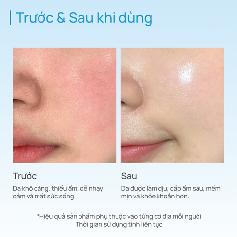 Mặt Nạ Thảo Dược Cấp Ẩm, Làm Dịu Da CHANDO Saussurea Soothing 5 MIẾNG