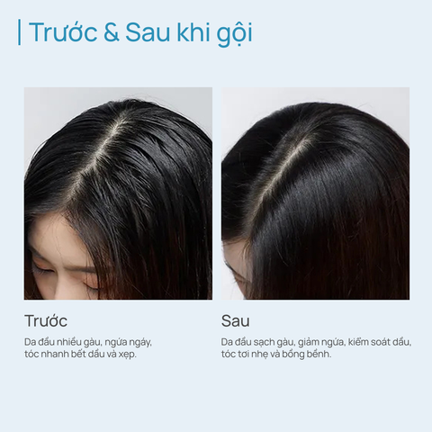 Dầu Gội 200ml Kiểm Soát Dầu/ Ngăn Ngừa Gàu CHANDO Himalaya