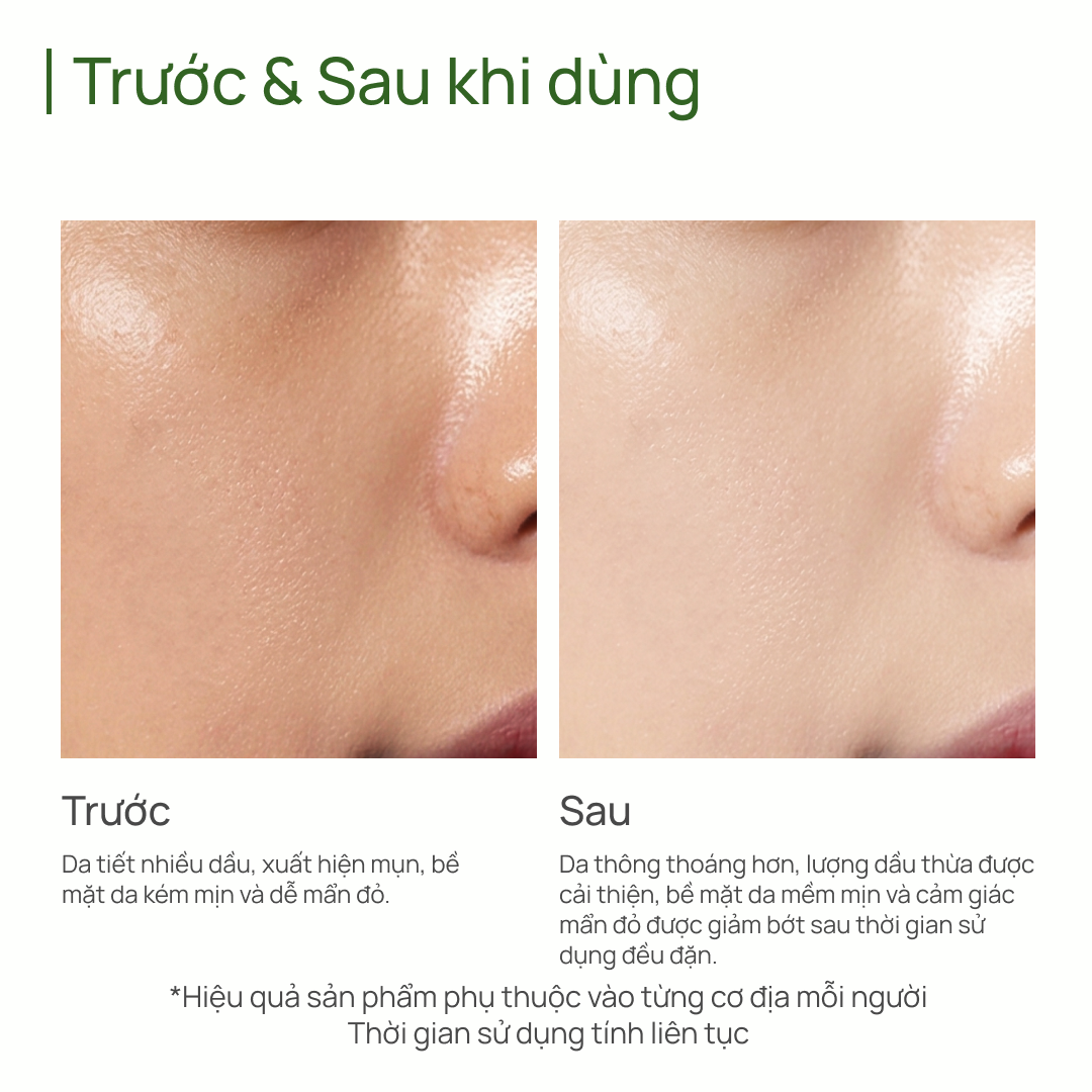 Toner Kiểm Soát Dầu & Ngăn Ngừa Mụn CHANDO Salicylic Acid Oil-control & Anti-acne Toner 150ml