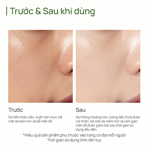 Toner Kiểm Soát Dầu & Ngăn Ngừa Mụn CHANDO Salicylic Acid Oil-control & Anti-acne Toner 150ml