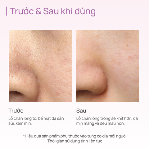 Mặt Nạ Thảo Dược Thu Nhỏ Lỗ Chân Lông CHANDO Comfrey Pore-tightening Mask 5 MIẾNG