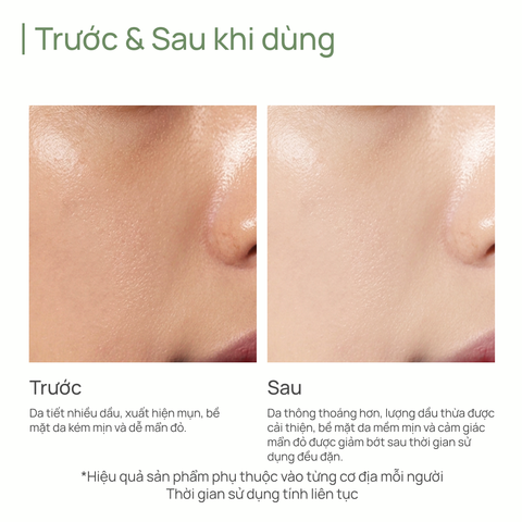 Tinh Chất Kiểm Soát Dầu & Ngăn Ngừa Mụn CHANDO Salicylic Acid Oil-control & Anti-acne Essence