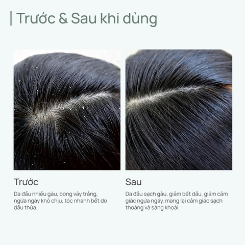 Dầu Gội Giảm Gàu & Giảm Ngứa Da Đầu CHANDO Anti-Dandruff & Itching Relief Shampoo 600ml