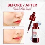 Serum tái tạo da sinh học Redpeel Tingle Serum 11ml