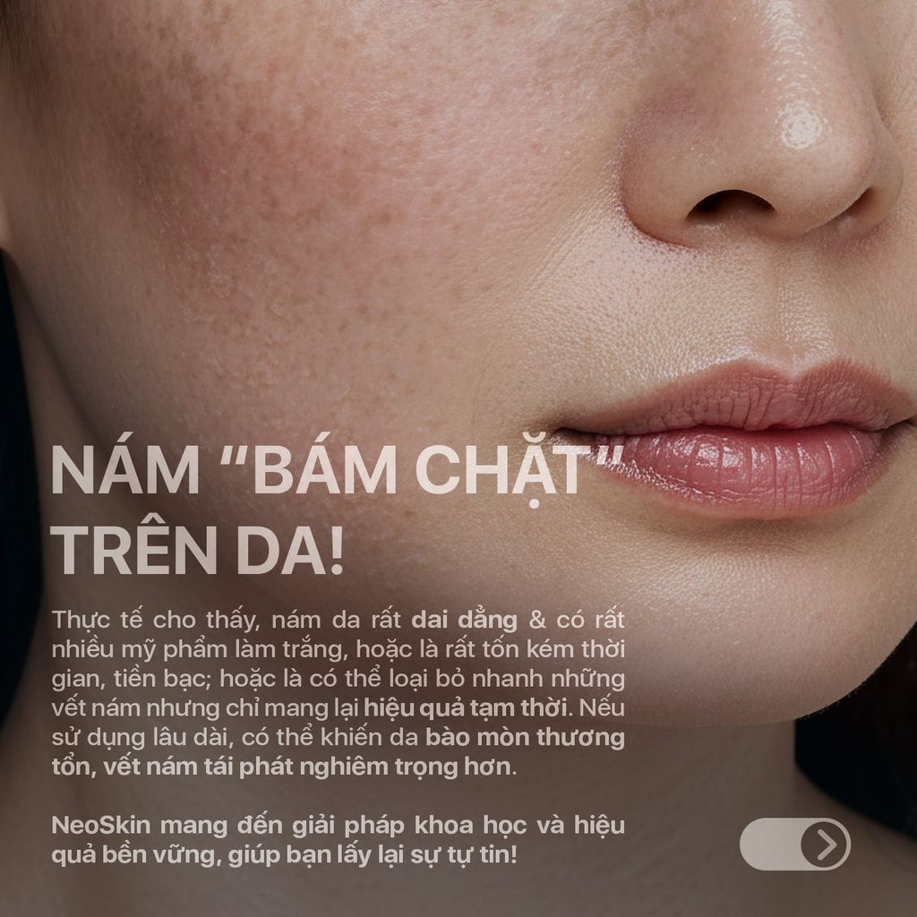 Kem Giảm Nám Da Chuẩn Khoa Học Triple Action T.A.K Hiệu Quả Chỉ Sau 7 Ngày NEOTHERA MELASMA CREAM 30ml (Chai)