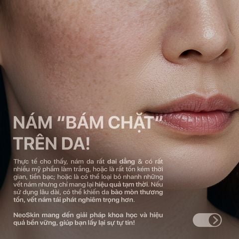 Kem giảm nám Neothera Melasma Cream - Kem Hỗ Trợ Giảm Nám Tranexamic Acid Hỗ Trợ Đều Màu Da Chuẩn Khoa Học (30ml)