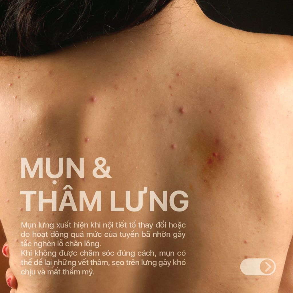 Xịt giảm mụn lưng NeoAcnes - Hỗ trợ giảm mụn cơ thể, giảm mụn lưng và ngừa thâm sẹo (100ml)