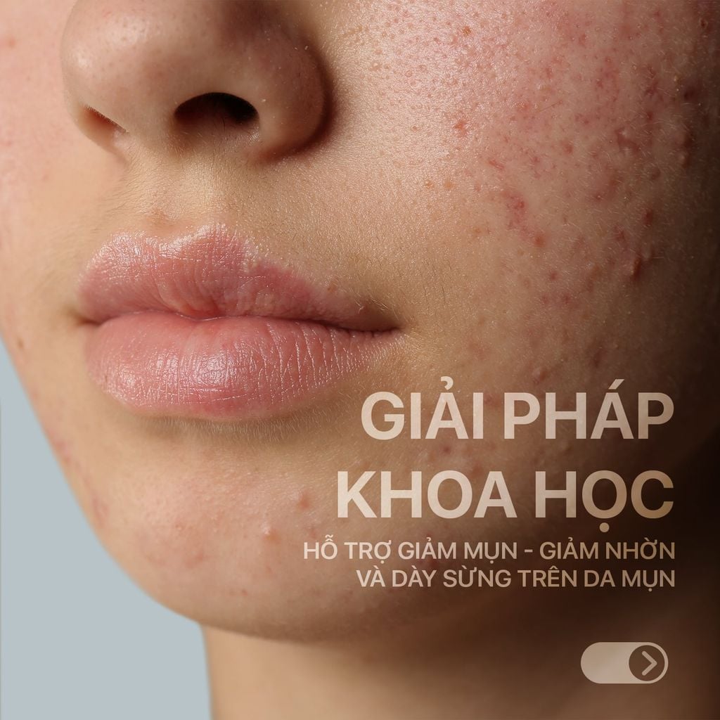 Combo 2 tuýp Neothera Acnes Gel (15ml x2)