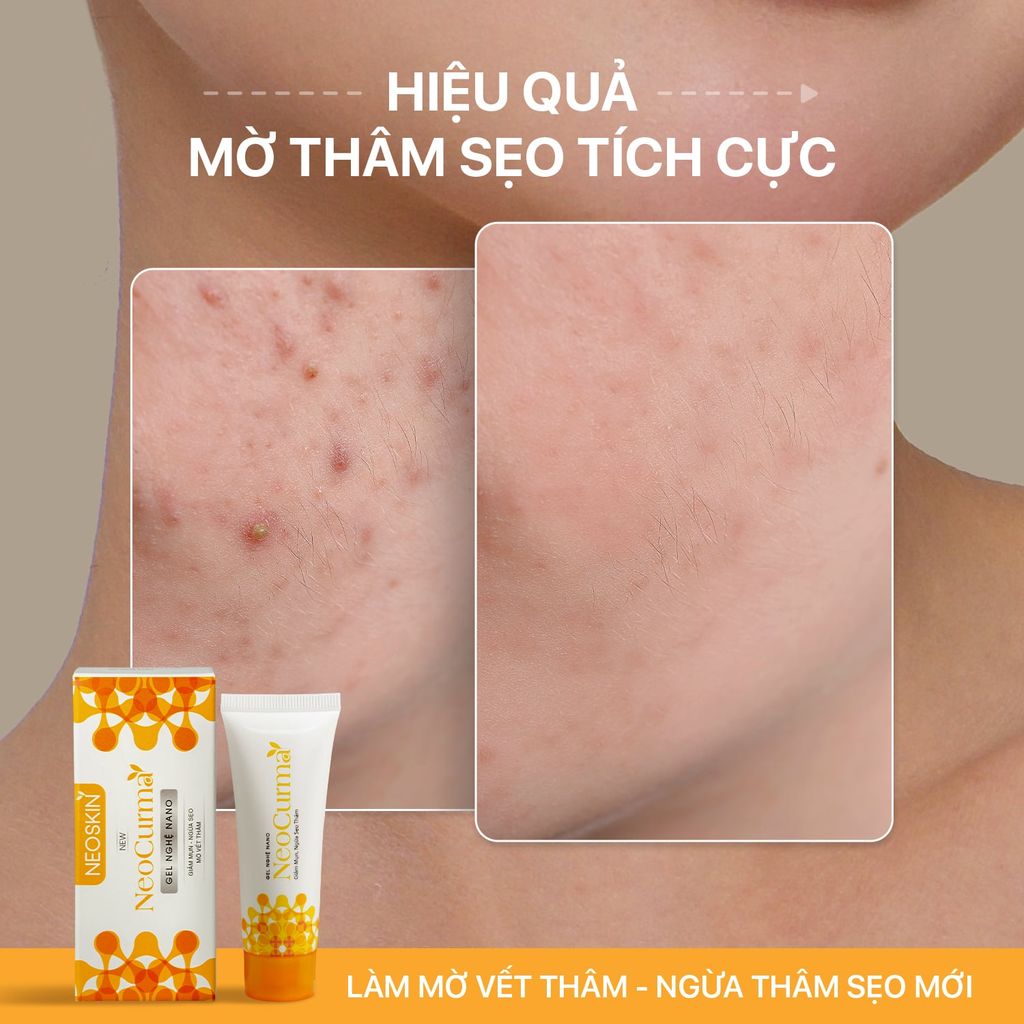 Gel Nghệ Nano NeoCurma – Giảm Mụn, Mờ Thâm Sẹo (20g)