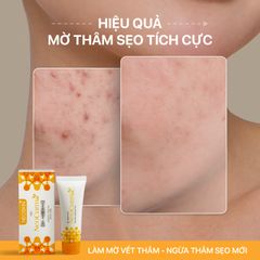 Gel Nghệ Nano NeoCurma – Giảm Mụn, Mờ Thâm Sẹo (20g)