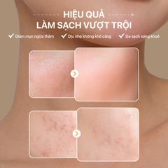 Sữa Rửa Mặt Nghệ NeoCleanser – Sạch Da, Kiểm Soát Nhờn, Ngừa Mụn Thâm (86g)
