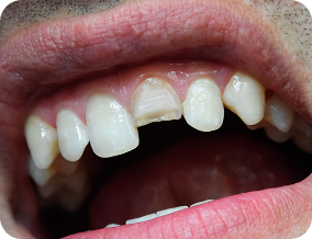 Mẻ răng gãy răng