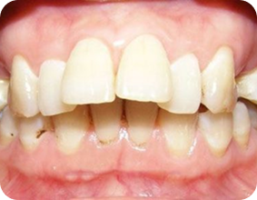 Hô móm răng thưa