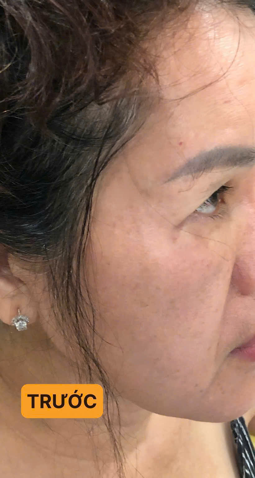 Trước khi nâng cơ